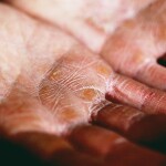 Przyczyny mrowienia dłoni
